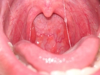 Faranjite İyi Gelen Bitkiler Nelerdir?